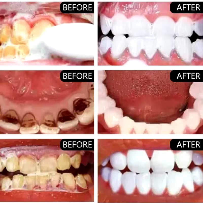 5 Days Teeth Whitening Powder Remove Plaque Stains Dental Calculus Oral Hygiene Cleaning Fresh Bad Breath Tooth Care Products